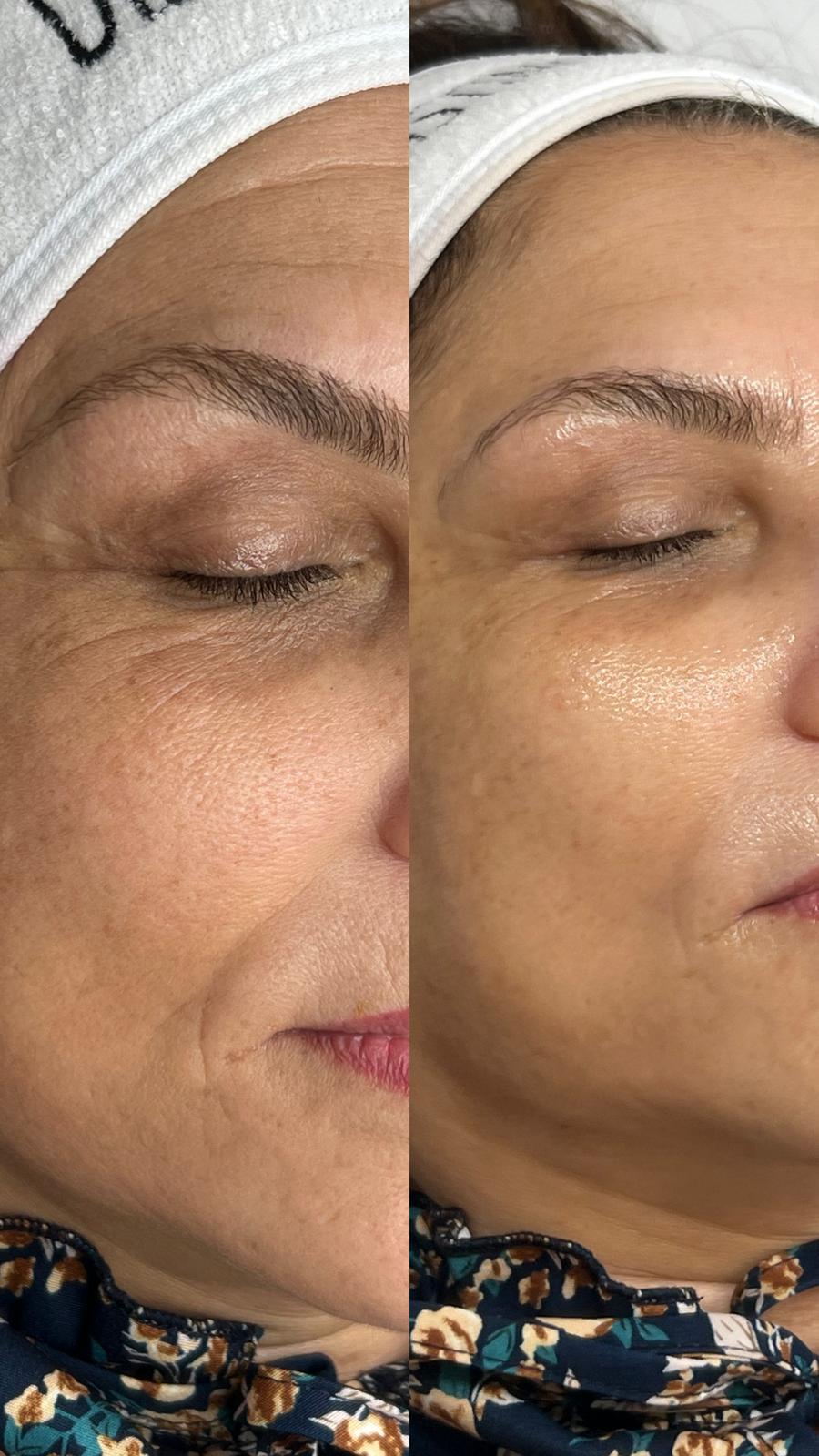 Avant / après soin du visage chez Distinction