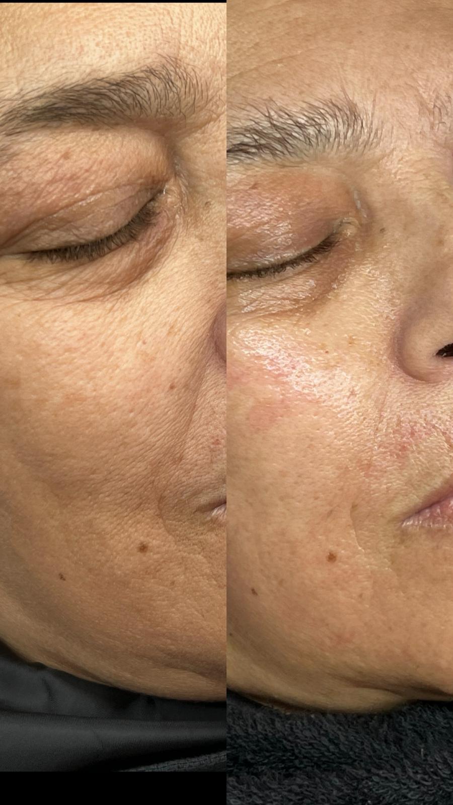 Avant / après soin du visage chez Distinction