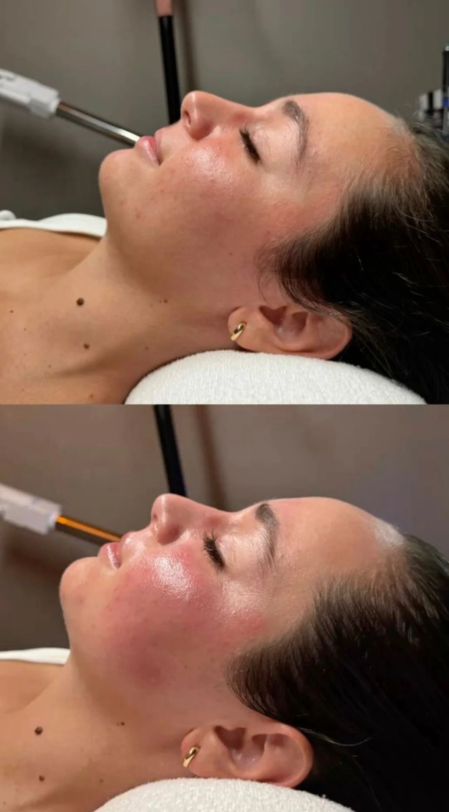 Avant / après soin du visage chez Distinction