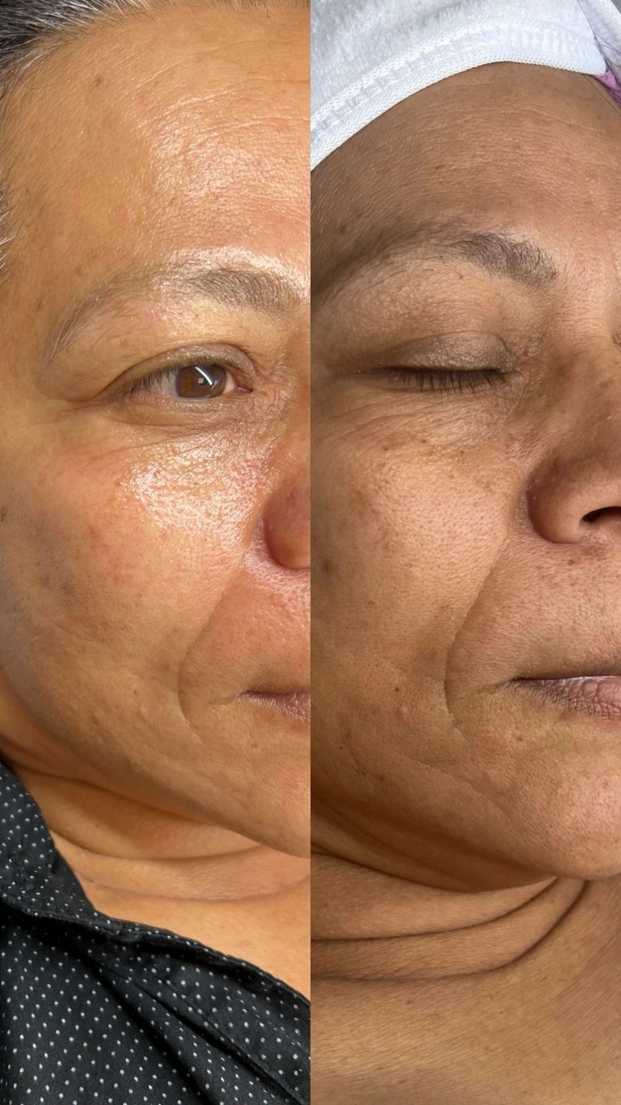 Avant / après soin du visage chez Distinction